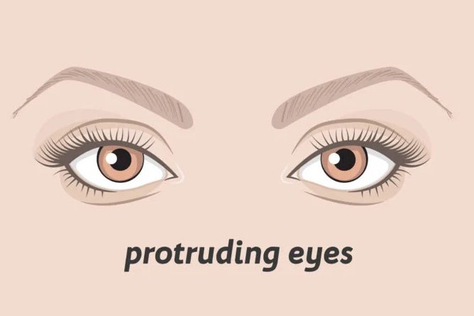 protruding eyes